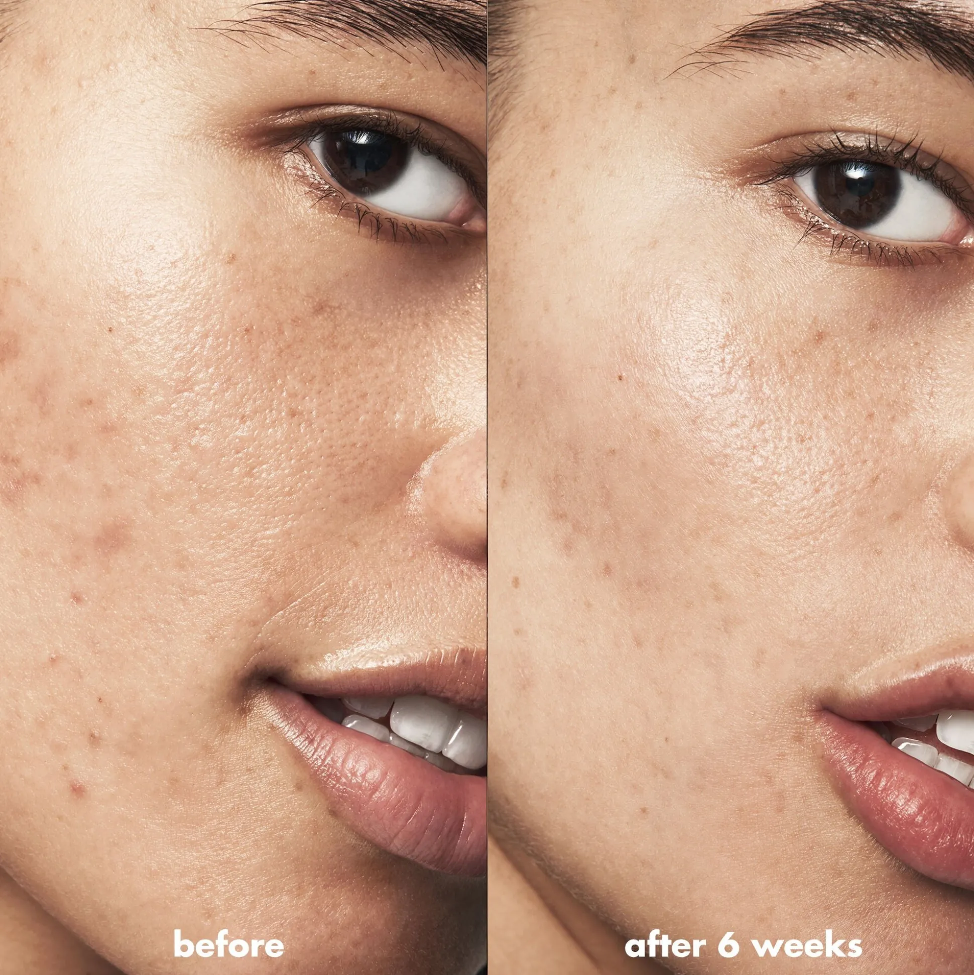 Blemish Breakthrough Acne Clarifying Cleanser