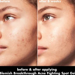 Blemish Breakthrough Acne Fighting Spot Gel