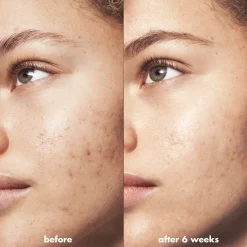 Blemish Breakthrough Triple-acid Resurfacing Serum