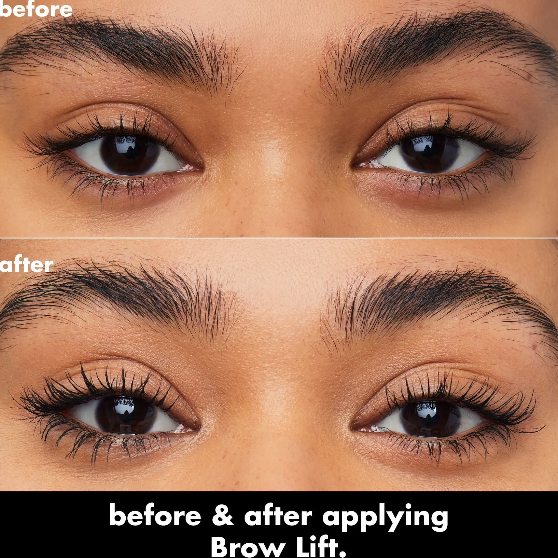 Brow Lift